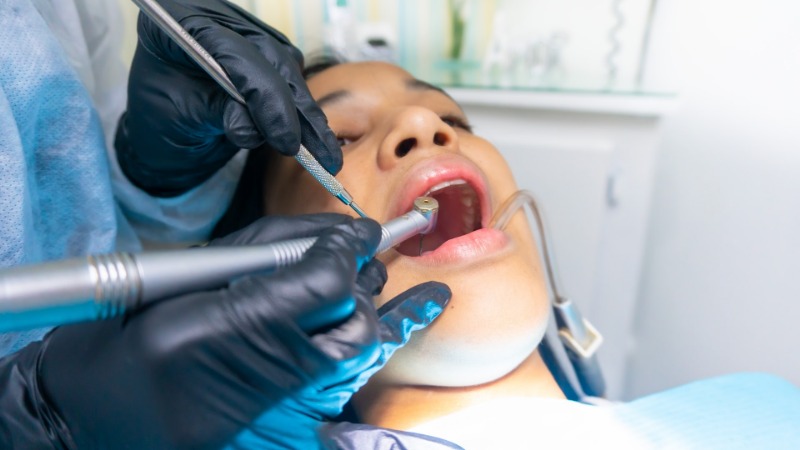 Tooth Cavities: Understanding Causes, Prevention, and Treatment